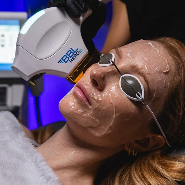 Patient receiving BBL HEROic light therapy treatment at Amer Clinic London