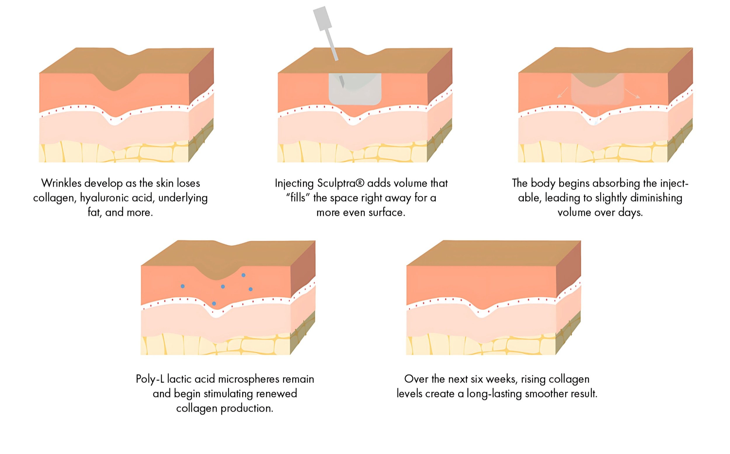 Illustration of collagen stimulation in body skin following Sculptra treatment at Amer Clinic London