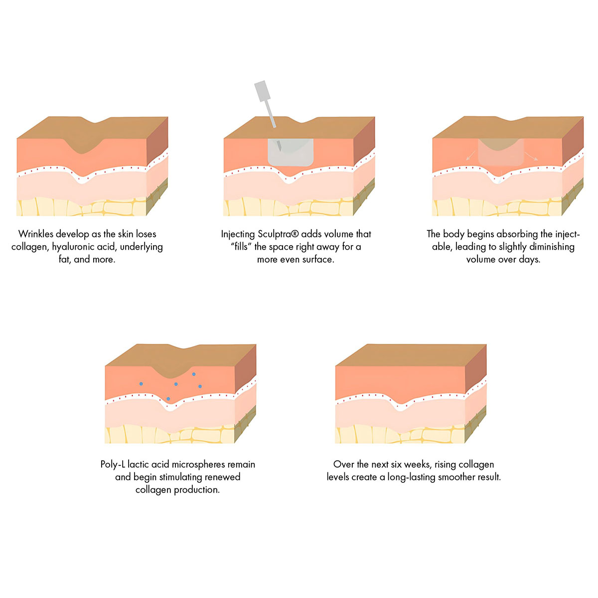 Diagram showing collagen stimulation process from biostimulator treatment