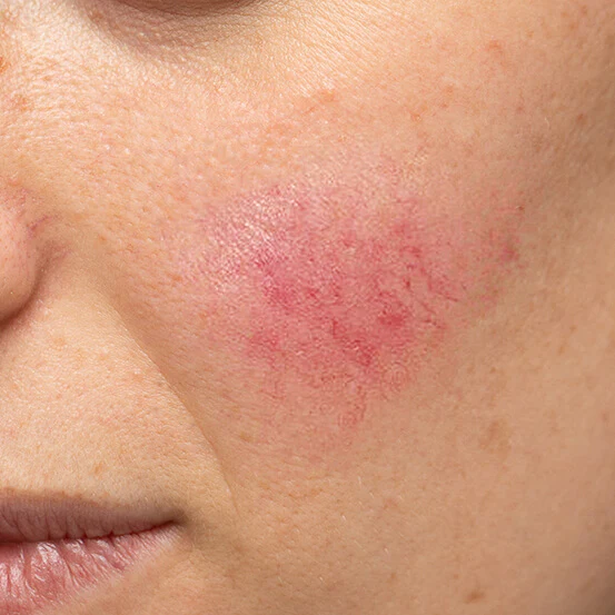 Rosacea