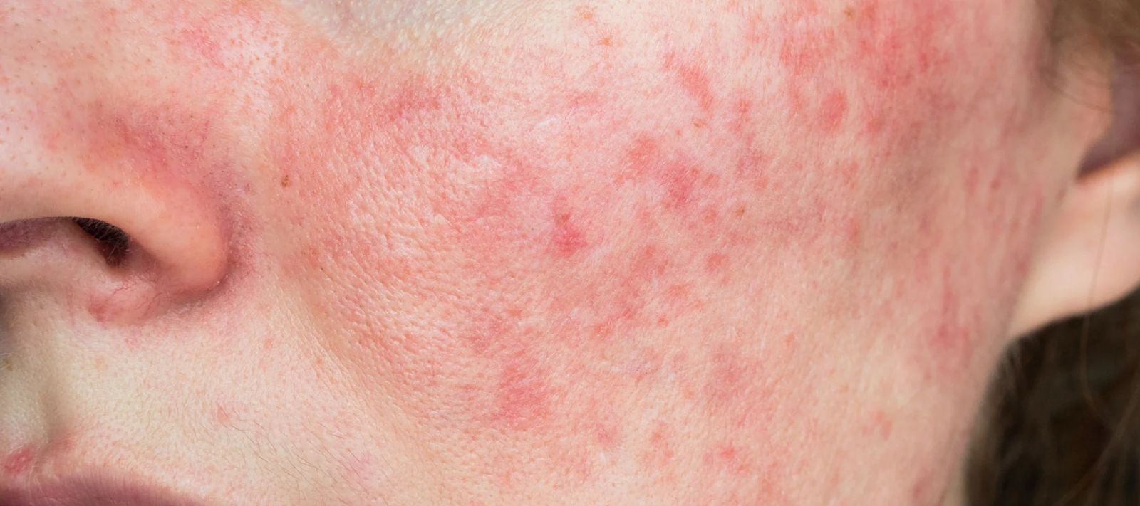 Inflammation