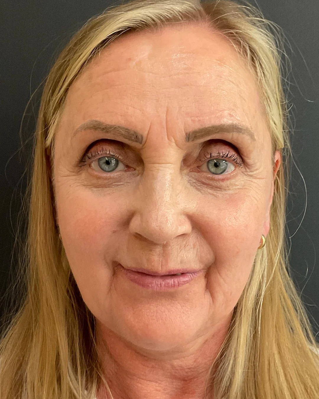After, BBL HEROic treatment at Amer Clinic London