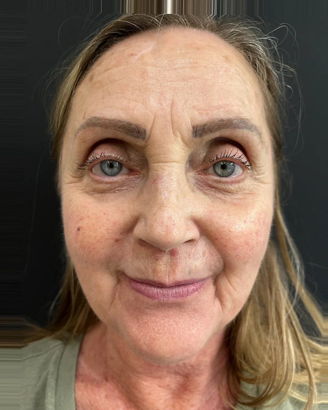 Before, BBL HEROic treatment at Amer Clinic London