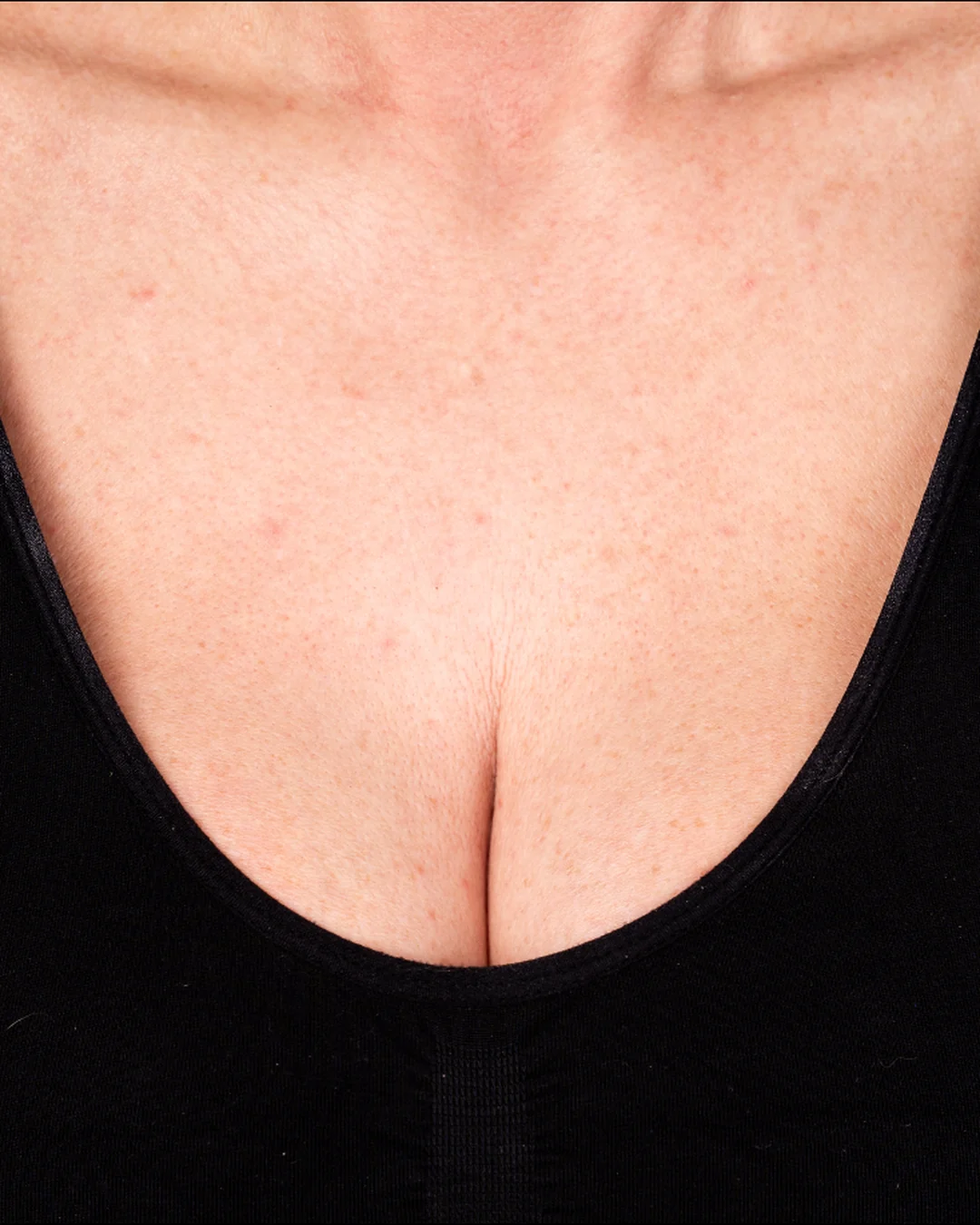 After Sculptra collagen treatment on the chest at Amer Clinic London