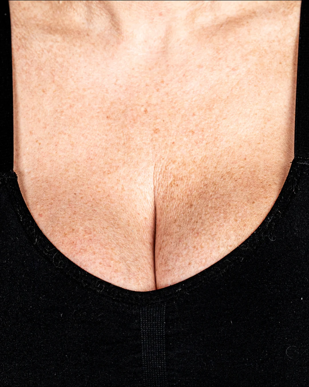 Before Sculptra collagen treatment on the chest at Amer Clinic London