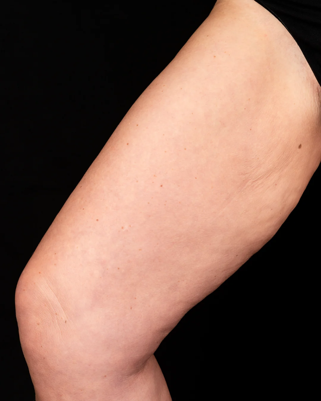Sculptra injectable biostimulator treatment being administered to the body at Amer Clinic London
