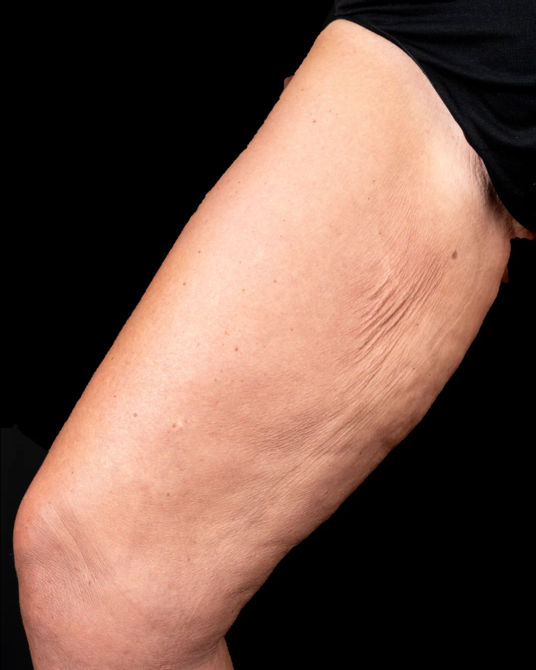 Before Sculptra collagen treatment on the legs at Amer Clinic London