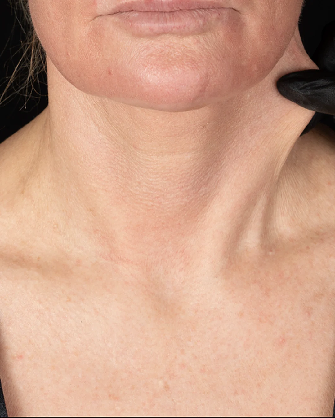 After Sculptra collagen treatment on the neck at Amer Clinic London