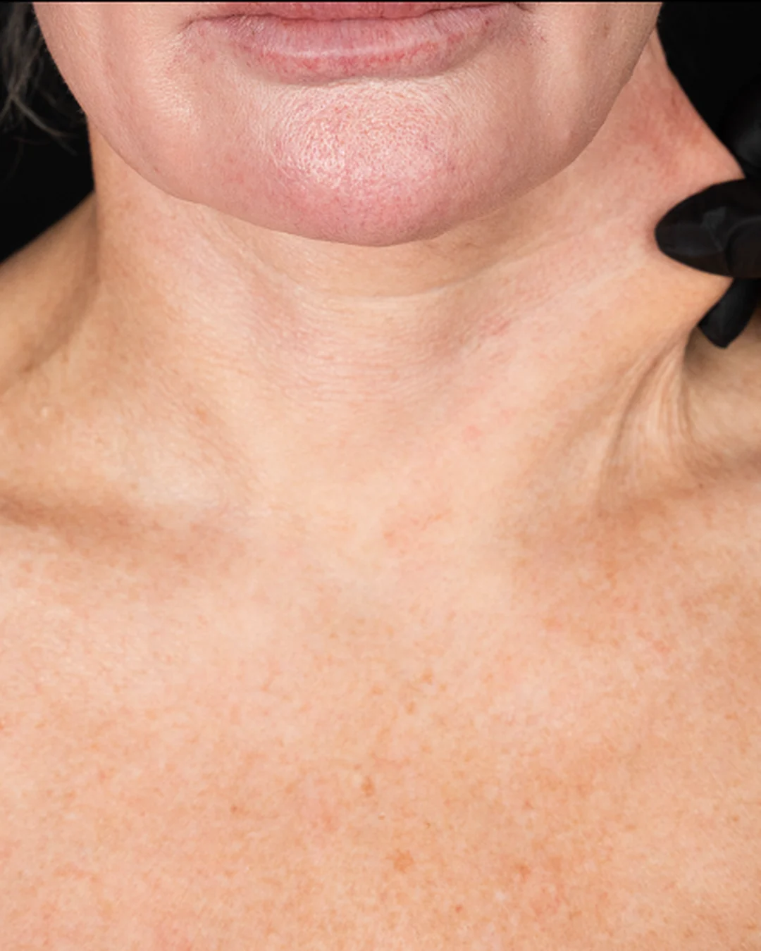 Before Sculptra collagen treatment on the neck at Amer Clinic London