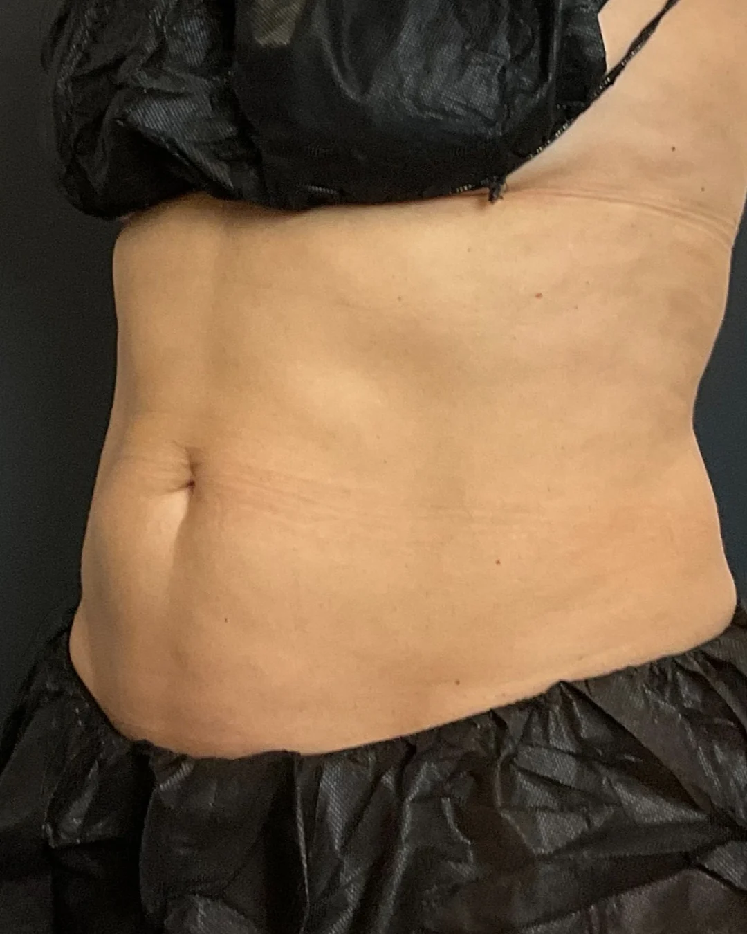 After, CoolSculpting abdomen treatment at Amer Clinic London