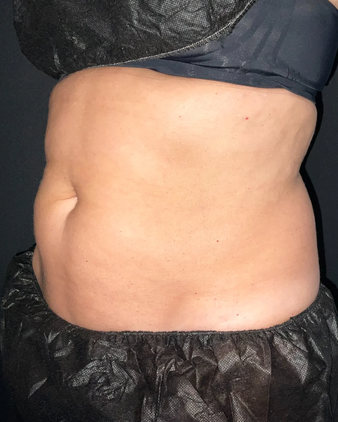 Before, CoolSculpting abdomen treatment at Amer Clinic London