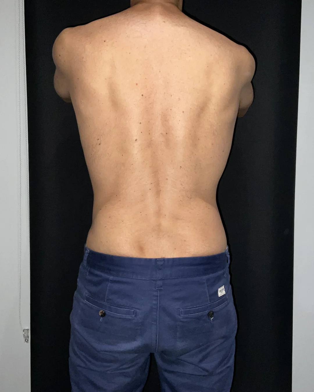 After, CoolSculpting flanks treatment at Amer Clinic London