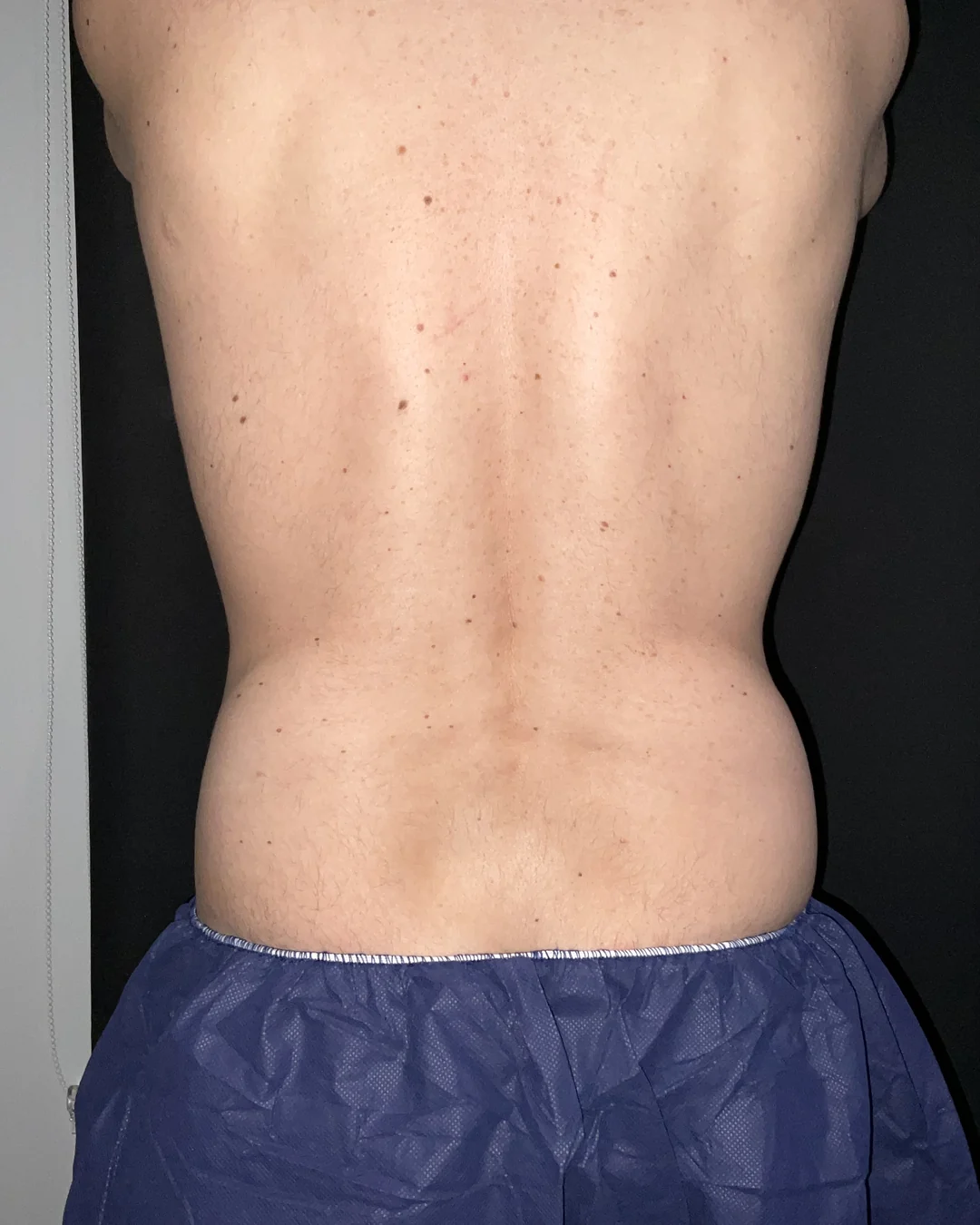 Before, CoolSculpting flanks treatment at Amer Clinic London