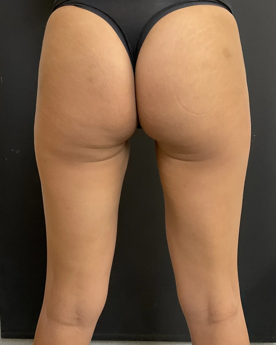 After, CoolSculpting legs treatment at Amer Clinic London