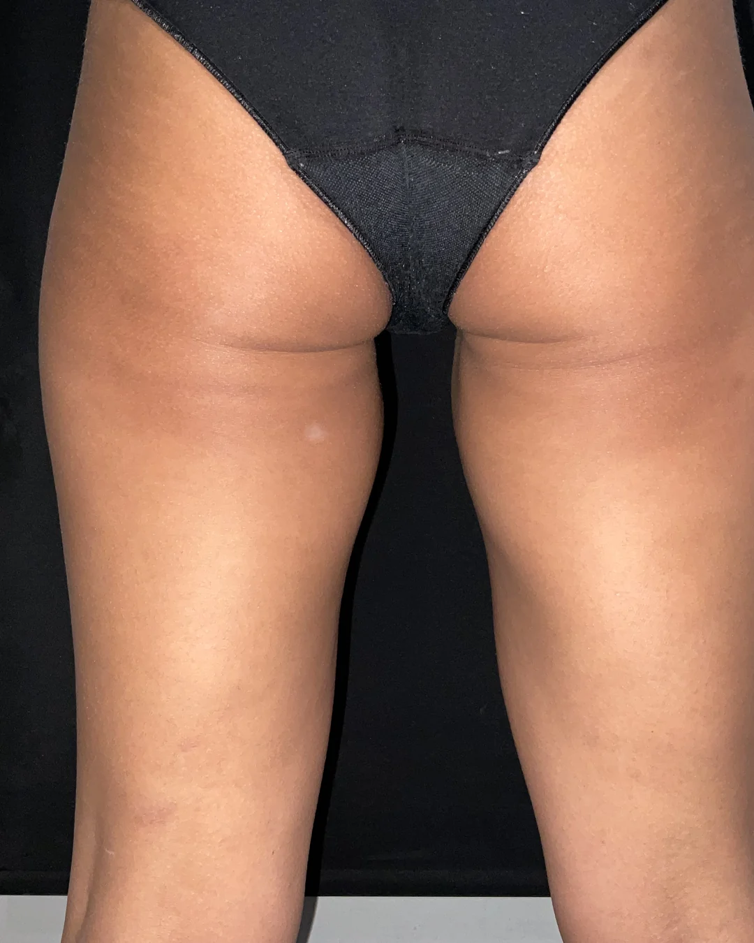 Before, CoolSculpting legs treatment at Amer Clinic London