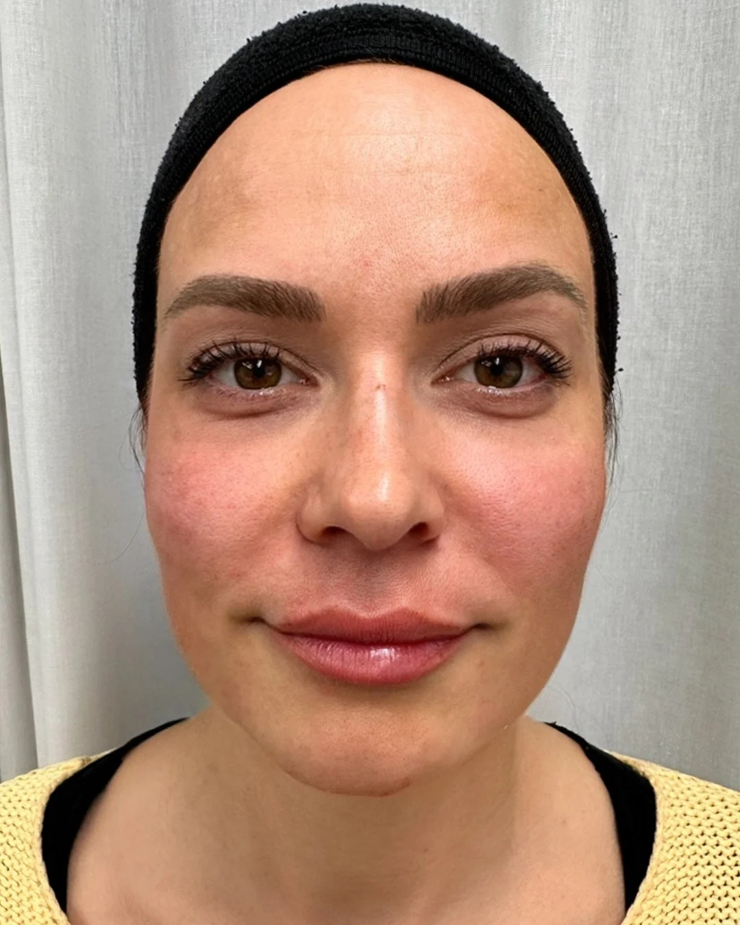 After, Dermal Fillers treatment at Amer Clinic London