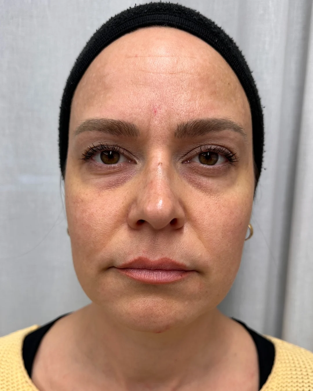 Before, Dermal Fillers treatment at Amer Clinic London