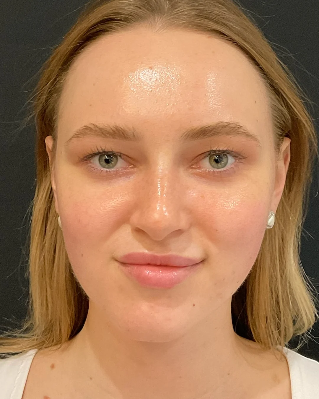 After, HydraFacial treatment at Amer Clinic London