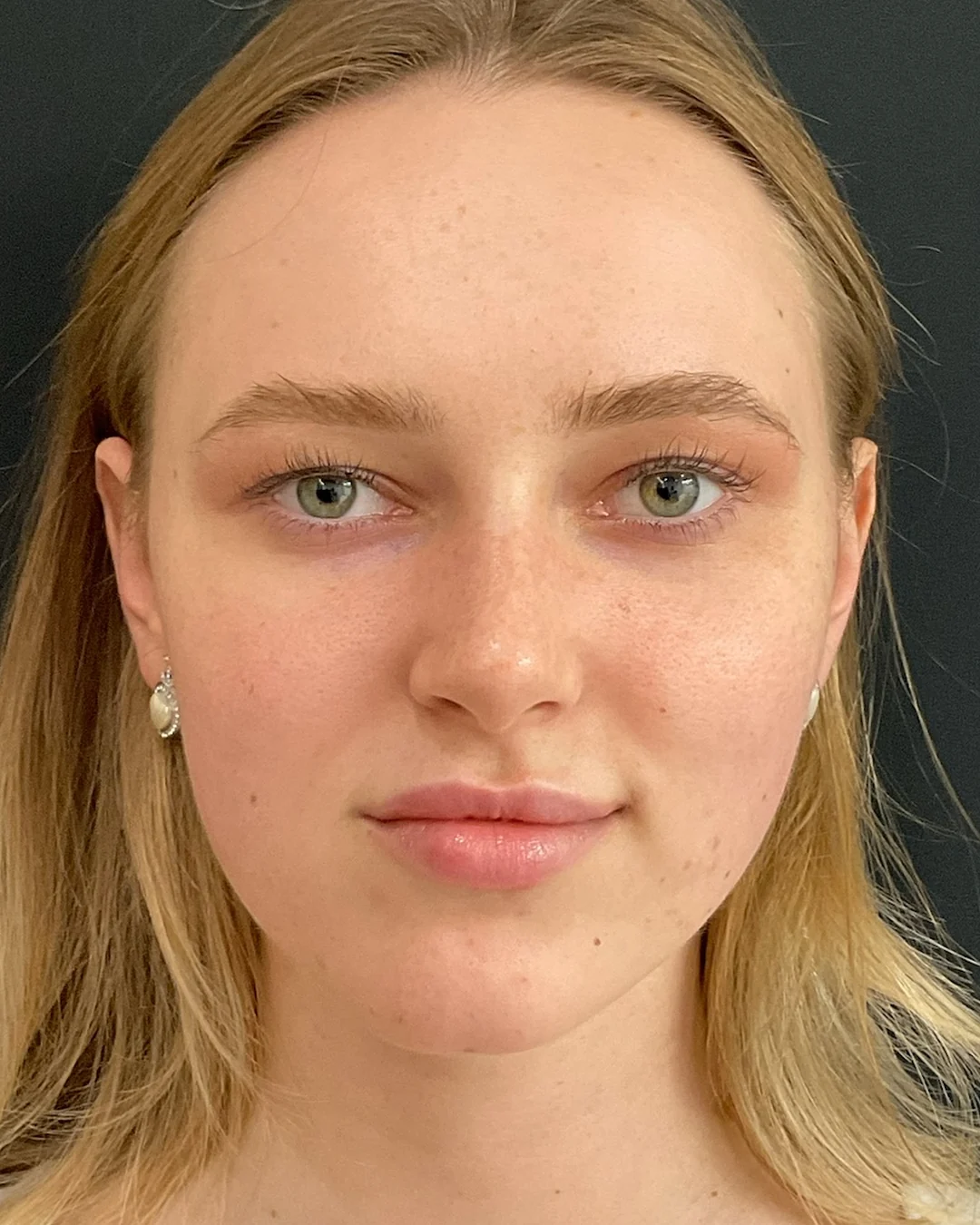 Before, HydraFacial treatment at Amer Clinic London