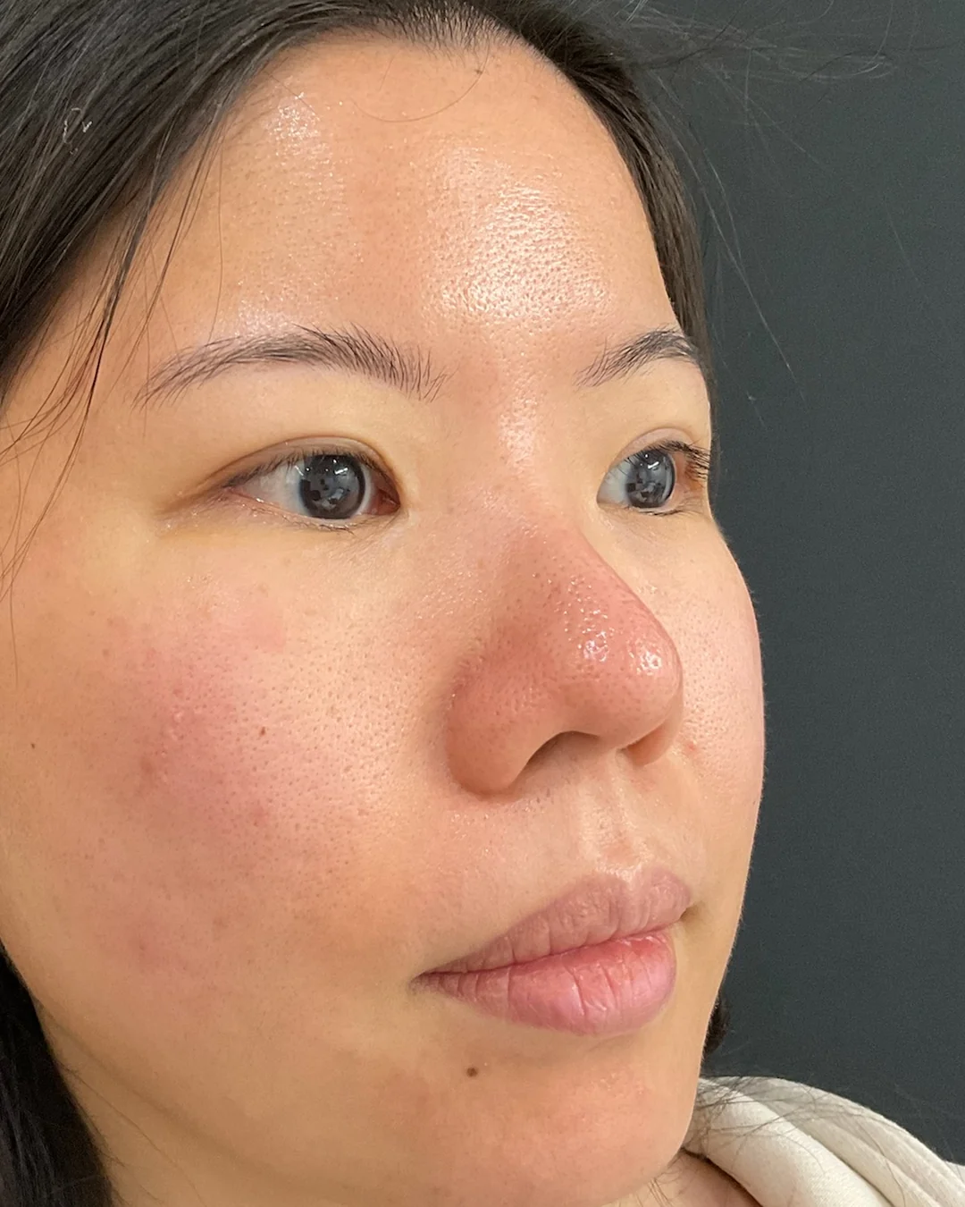 After, Laser Genesis treatment at Amer Clinic London