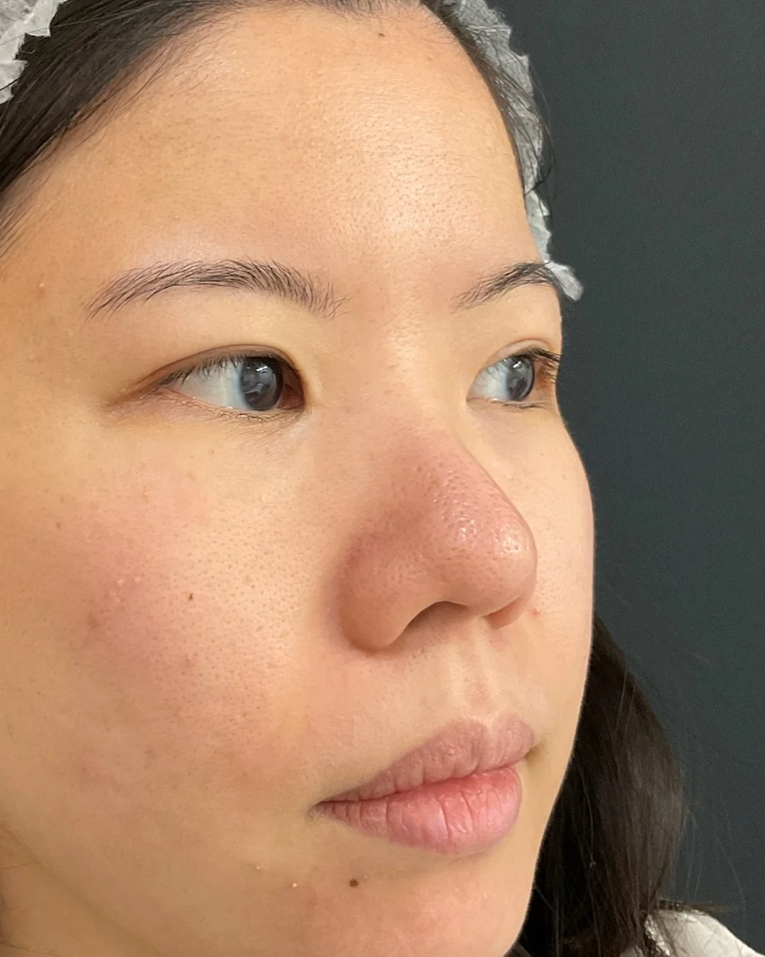 Before, Laser Genesis treatment at Amer Clinic London