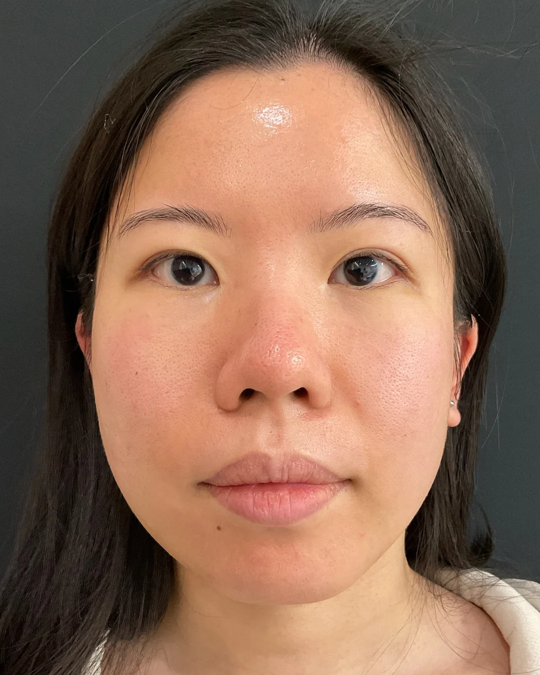 After, Laser Genesis treatment at Amer Clinic London
