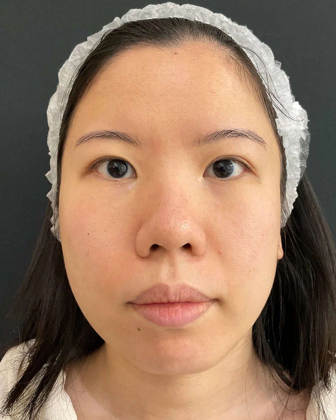 Before, Laser Genesis treatment at Amer Clinic London