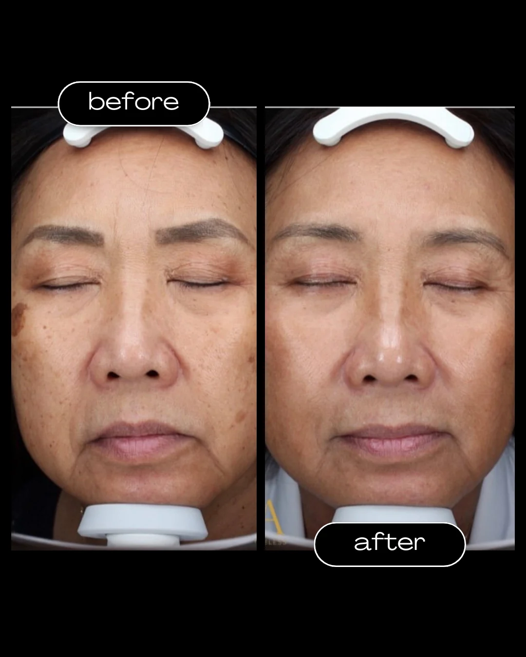 Moxi Laser before and after results at Amer Clinic London