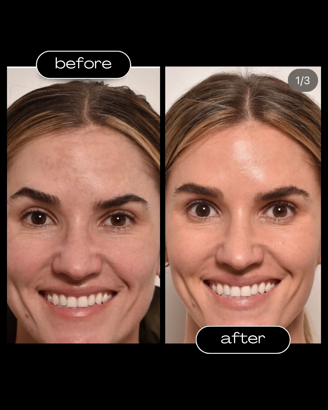 Moxi Laser before and after results at Amer Clinic London