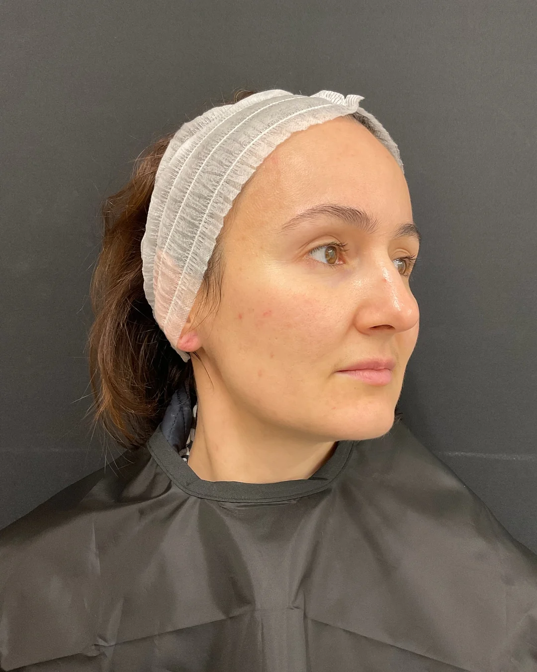 After, Polynucleotides treatment at Amer Clinic London