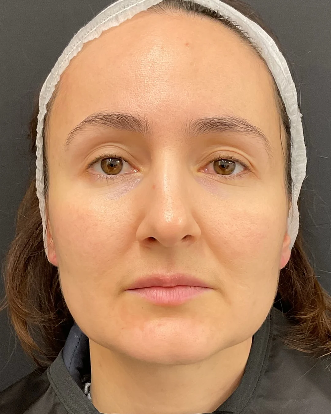 After, Polynucleotides treatment at Amer Clinic London