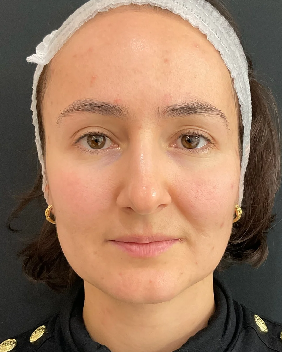 Before, Polynucleotides treatment at Amer Clinic London