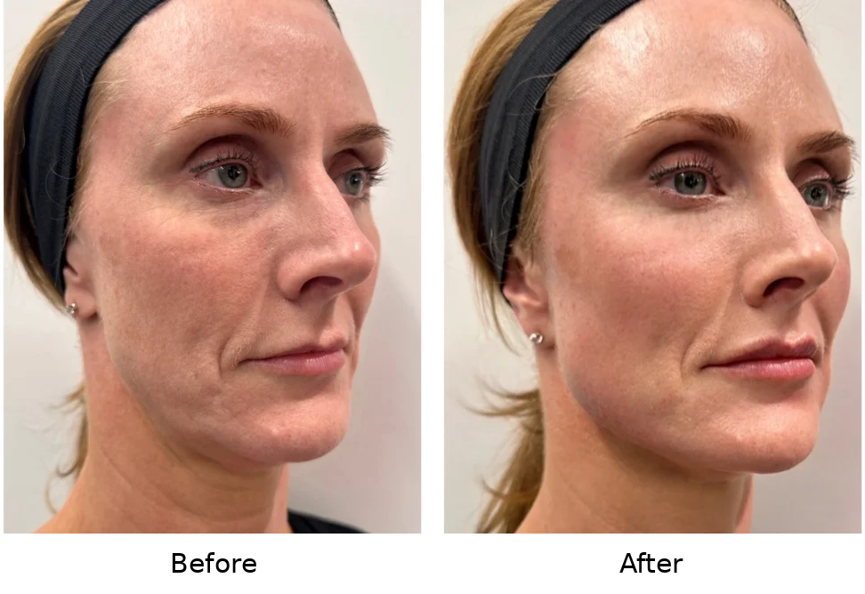 sculptra before and after